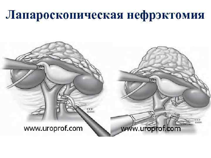 Лапароскопическая нефрэктомия 