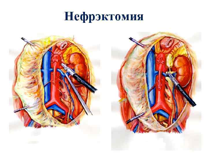 Нефрэктомия 