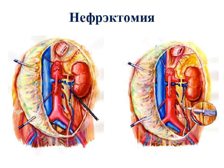 Нефрэктомия 