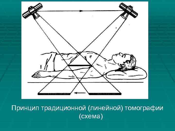 Принцип традиционной (линейной) томографии (схема) 