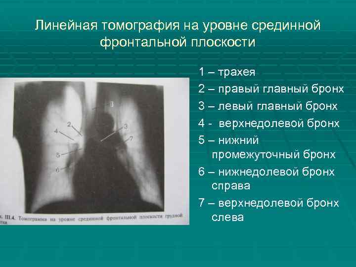 Линейная томография на уровне срединной фронтальной плоскости 1 – трахея 2 – правый главный