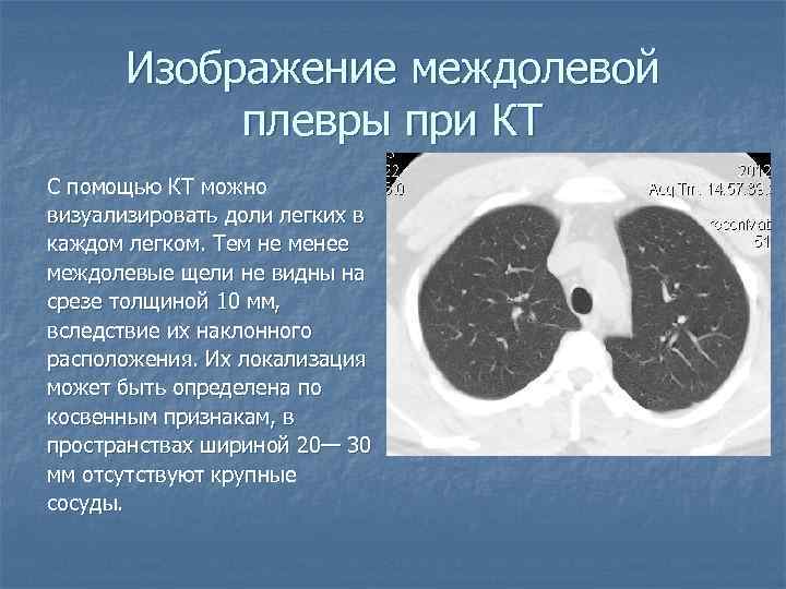 Изображение междолевой плевры при КТ С помощью КТ можно визуализировать доли легких в каждом