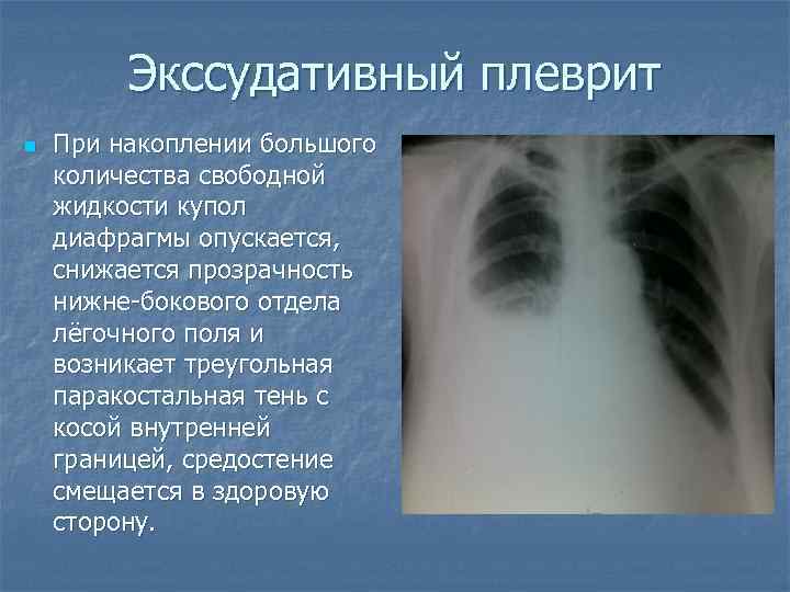 Экссудативный плеврит n При накоплении большого количества свободной жидкости купол диафрагмы опускается, снижается прозрачность