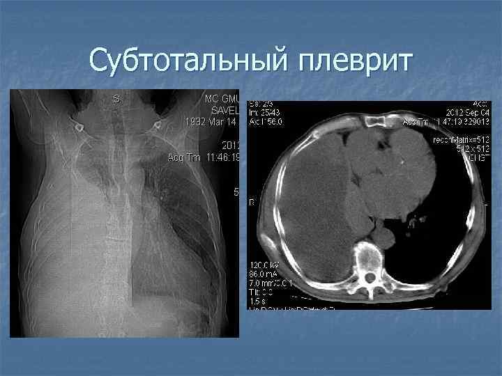 Субтотальный плеврит 