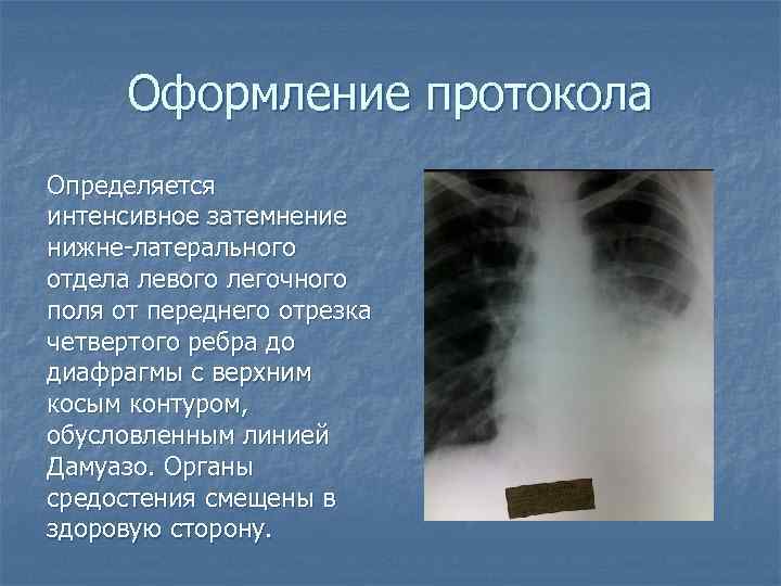 Оформление протокола Определяется интенсивное затемнение нижне-латерального отдела левого легочного поля от переднего отрезка четвертого
