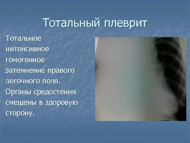 Тотальный плеврит Тотальное интенсивное гомогенное затемнение правого легочного поля. Органы средостения смещены в здоровую