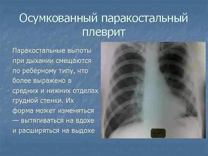 Осумкованный паракостальный плеврит Паракостальные выпоты при дыхании смещаются по реберному типу, что более выражено