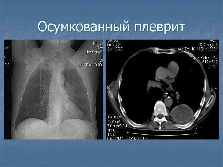 Осумкованный плеврит 