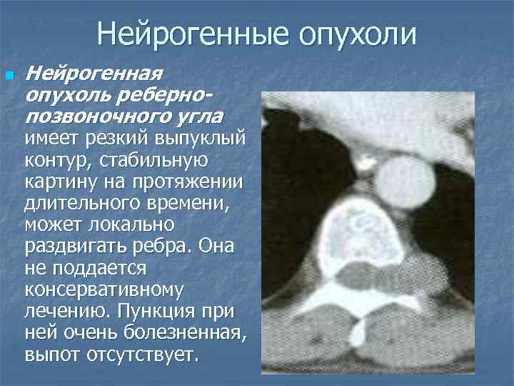 Нейрогенные опухоли n Нейрогенная опухоль ребернопозвоночного угла имеет резкий выпуклый контур, стабильную картину на