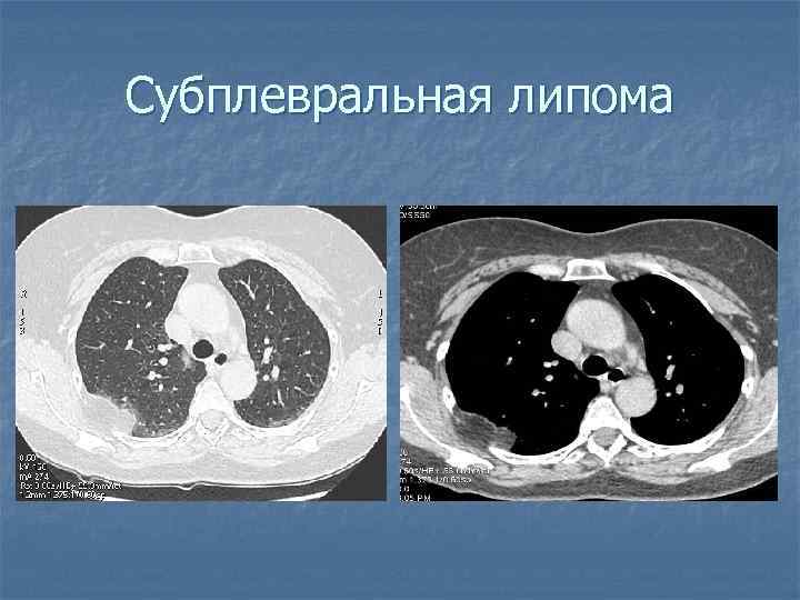 Субплевральная липома 