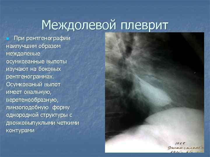 Междолевой плеврит При рентгенографии наилучшим образом междолевые осумкованные выпоты изучают на боковых рентгенограммах. Осумкованый