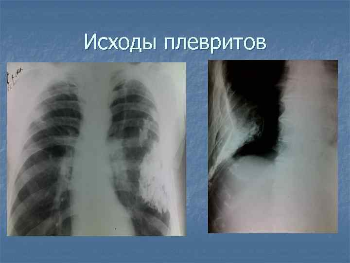 Исходы плевритов 