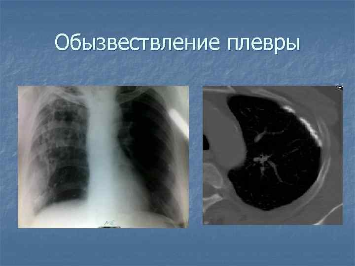 Обызвествление плевры 
