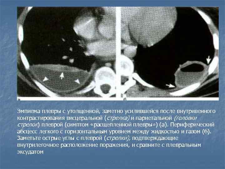 Эмпиема плевры с утолщенной, заметно усилившейся после внутривенного контрастирования висцеральной (стрелка) и париетальной (головки
