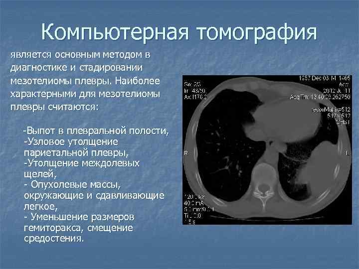 Компьютерная томография является основным методом в диагностике и стадировании мезотелиомы плевры. Наиболее характерными для