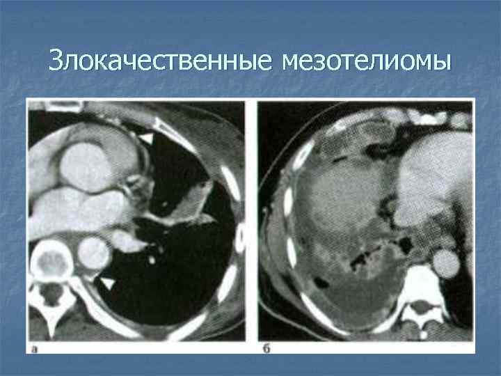 Злокачественные мезотелиомы 