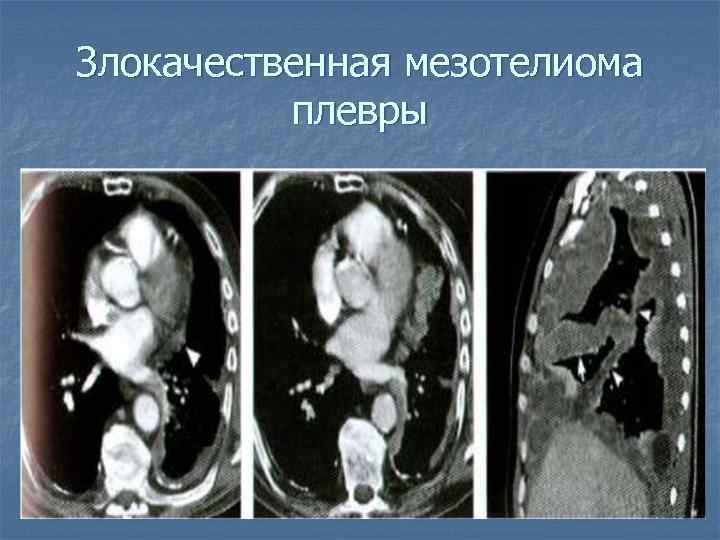 Злокачественная мезотелиома плевры 
