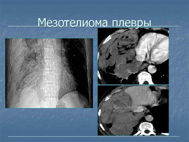 Мезотелиома плевры 