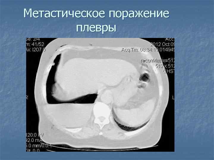 Метастическое поражение плевры 