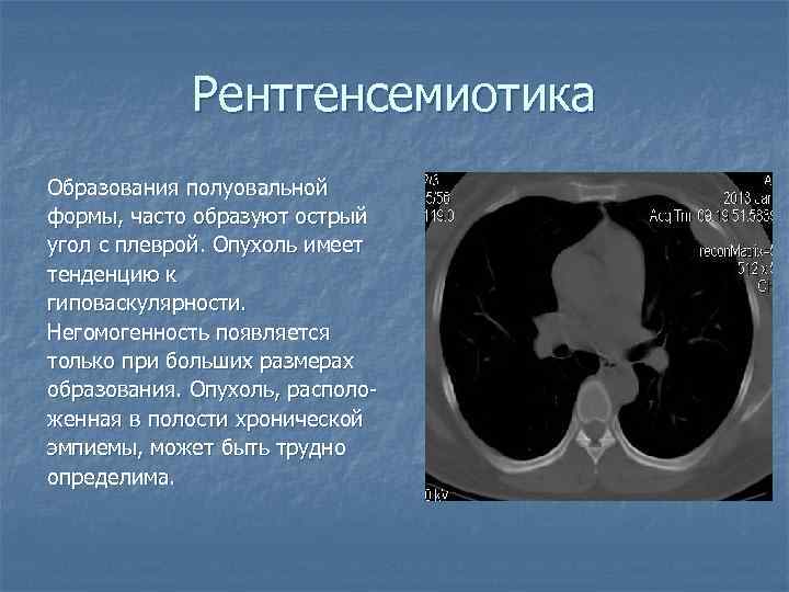 Рентгенсемиотика Образования полуовальной формы, часто образуют острый угол с плеврой. Опухоль имеет тенденцию к