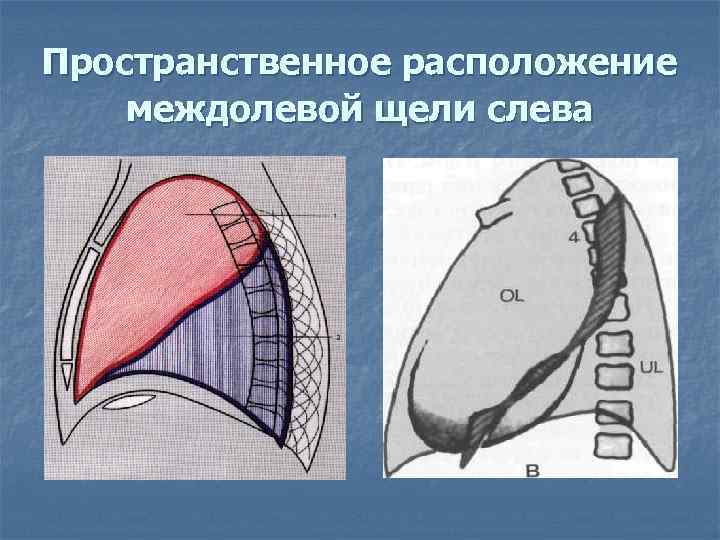 Пространственное расположение междолевой щели слева 