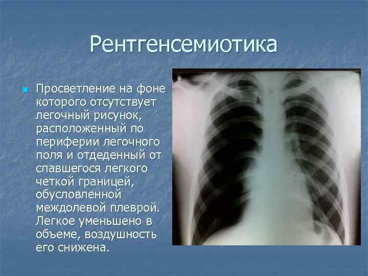Рентгенсемиотика n Просветление на фоне которого отсутствует легочный рисунок, расположенный по периферии легочного поля
