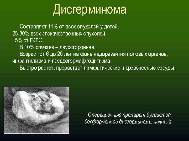 Дисгерминома Составляет 11% от всех опухолей у детей. 25 -30% всех злокачественных опухолей. 15%