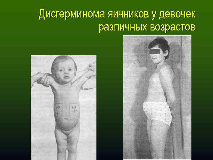 Дисгерминома яичников у девочек различных возрастов 