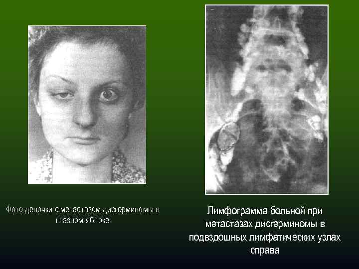 Фото девочки с метастазом дисгерминомы в глазном яблоке Лимфограмма больной при метастазах дисгерминомы в
