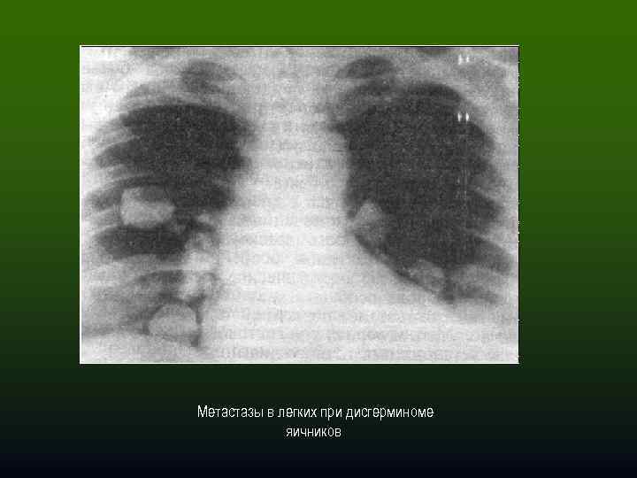  Метастазы в легких при дисгерминоме яичников 