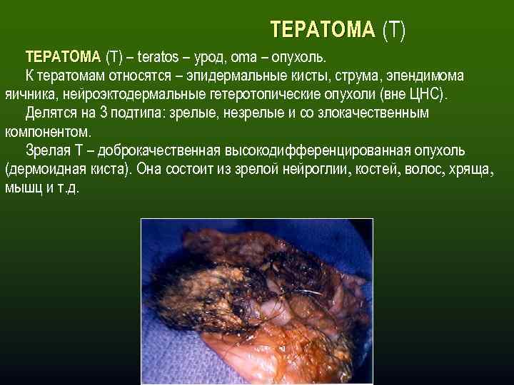 ТЕРАТОМА (Т) – teratos – урод, oma – опухоль. К тератомам относятся – эпидермальные