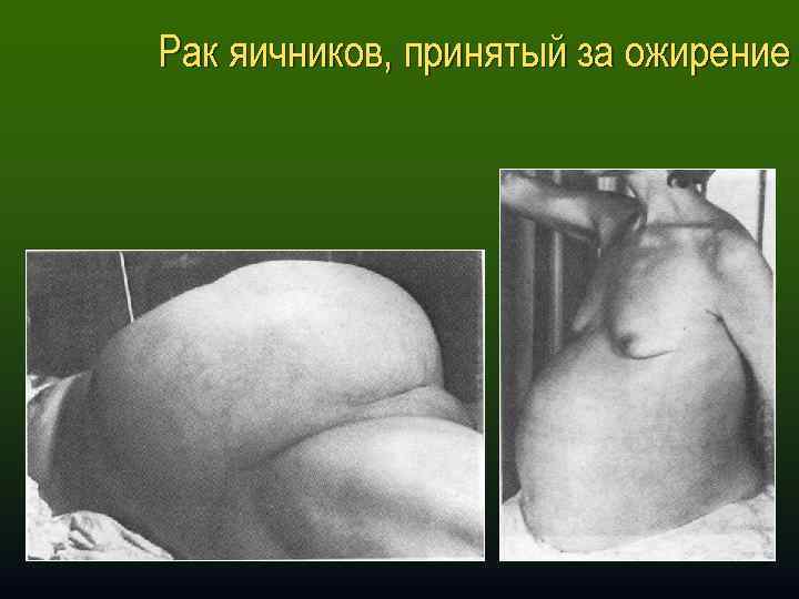 Рак яичников, принятый за ожирение 