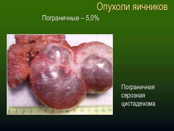 Опухоли яичников Пограничные – 5, 0% Пограничная серозная цистаденома 