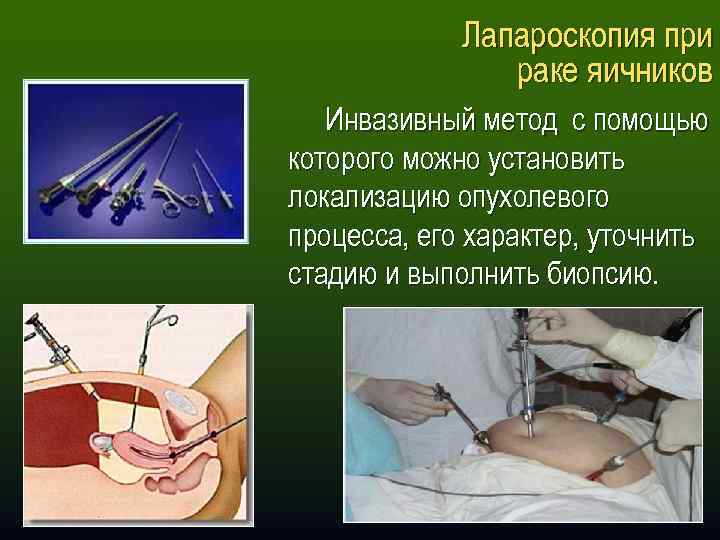 Лапароскопия при раке яичников Инвазивный метод с помощью которого можно установить локализацию опухолевого процесса,