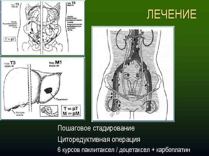 ЛЕЧЕНИЕ Пошаговое стадирование Циторедуктивная операция 6 курсов паклитаксел / доцетаксел + карбоплатин 
