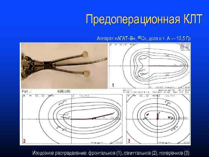 Предоперационная КЛТ Аппарат «АГАТ–В» , 60 Со, доза в т. А — 13, 5