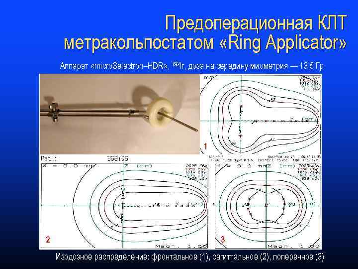 Предоперационная КЛТ метракольпостатом «Ring Applicator» Аппарат «micro. Selectron–HDR» , 192 Ir, доза на середину