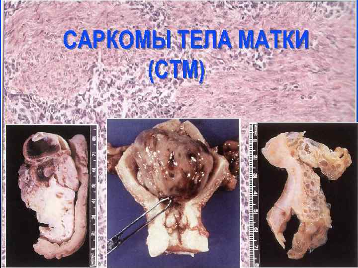 САРКОМЫ ТЕЛА МАТКИ (СТМ) 