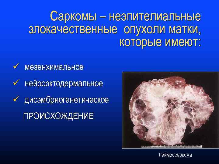 Саркомы – неэпителиальные злокачественные опухоли матки, которые имеют: ü мезенхимальное ü нейроэктодермальное ü дисэмбриогенетическое