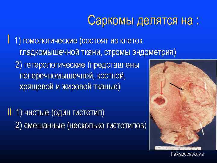 Саркомы делятся на : I 1) гомологические (состоят из клеток гладкомышечной ткани, стромы эндометрия)