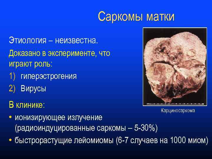 Саркомы матки Этиология – неизвестна. Доказано в эксперименте, что играют роль: 1) гиперэстрогения 2)