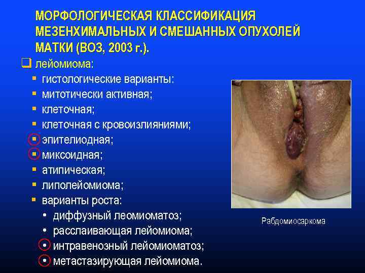 МОРФОЛОГИЧЕСКАЯ КЛАССИФИКАЦИЯ МЕЗЕНХИМАЛЬНЫХ И СМЕШАННЫХ ОПУХОЛЕЙ МАТКИ (ВОЗ, 2003 г. ). q лейомиома: §