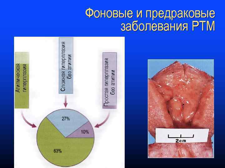 Простая гиперплазия без атипии Сложная гиперплазия без атипии Атипмческая гиперплазия Фоновые и предраковые заболевания