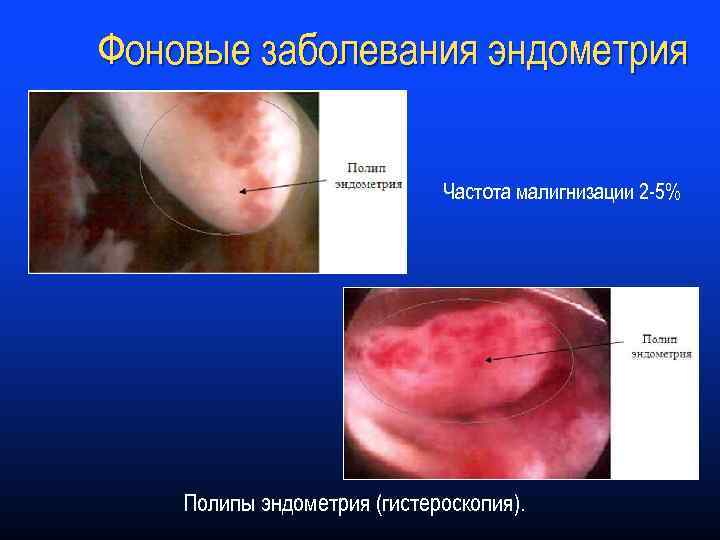 Фоновые заболевания эндометрия Частота малигнизации 2 -5% Полипы эндометрия (гистероскопия). 