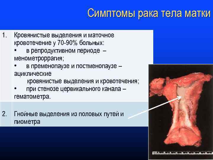 Симптомы рака тела матки 1. Кровянистые выделения и маточное кровотечение у 70 -90% больных:
