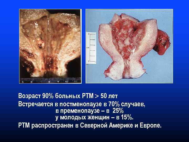 Возраст 90% больных РТМ 50 лет Встречается в постменопаузе в 70% случаев, в пременопаузе