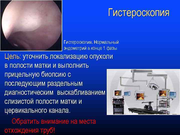 Гистероскопия. Нормальный эндометрий в конце 1 фазы Цель: уточнить локализацию опухоли в полости матки