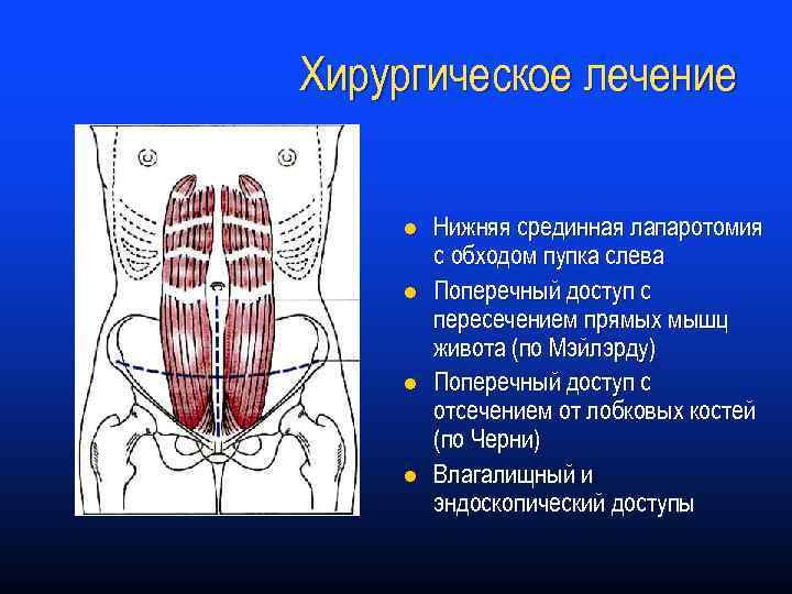 Хирургическое лечение l l Нижняя срединная лапаротомия с обходом пупка слева Поперечный доступ с