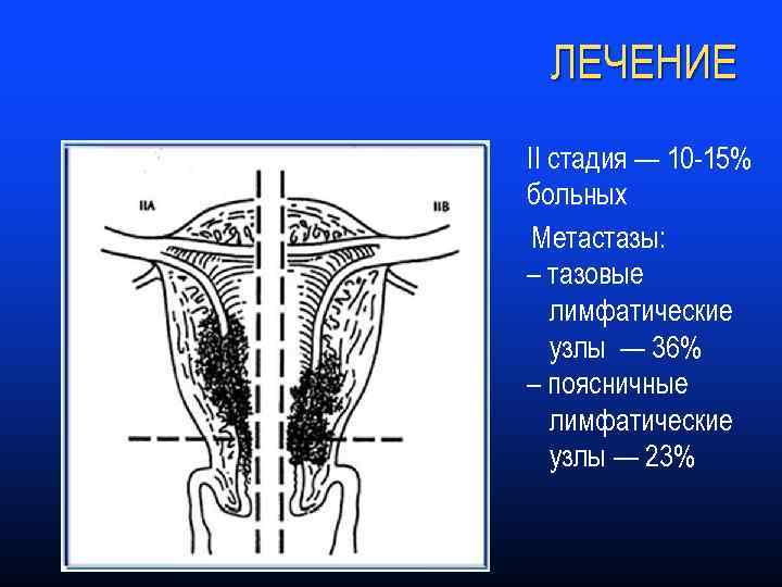 ЛЕЧЕНИЕ II стадия — 10 -15% больных Метастазы: – тазовые лимфатические узлы — 36%