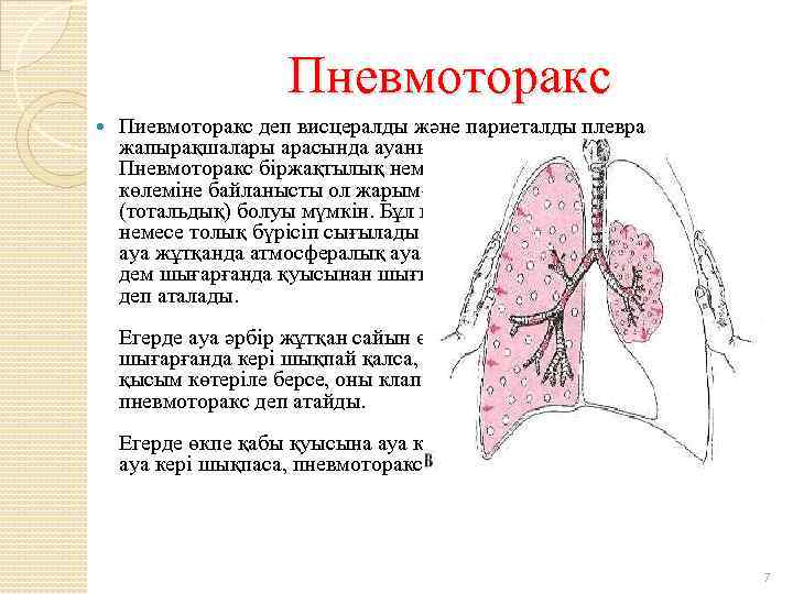 Пневмоторакс Пиевмоторакс деп висцералды және париеталды плевра жапырақшалары арасында ауаның жиналуын атаймыз. Пневмоторакс біржақтылық